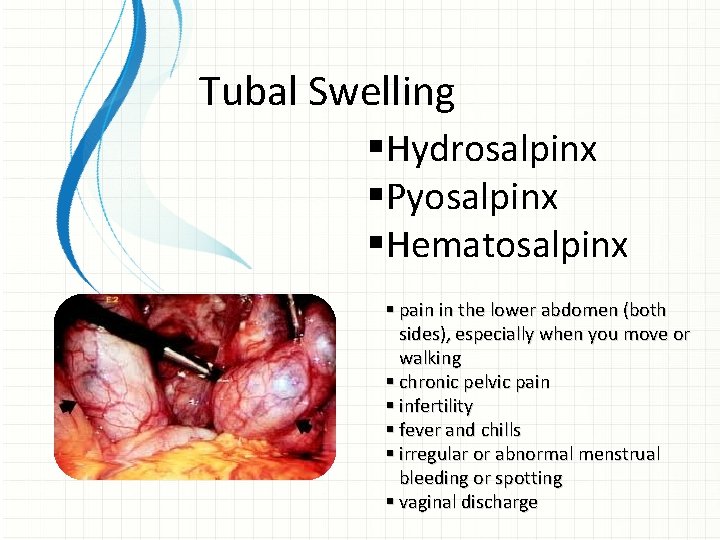 Tubal Swelling §Hydrosalpinx §Pyosalpinx §Hematosalpinx § pain in the lower abdomen (both sides), especially