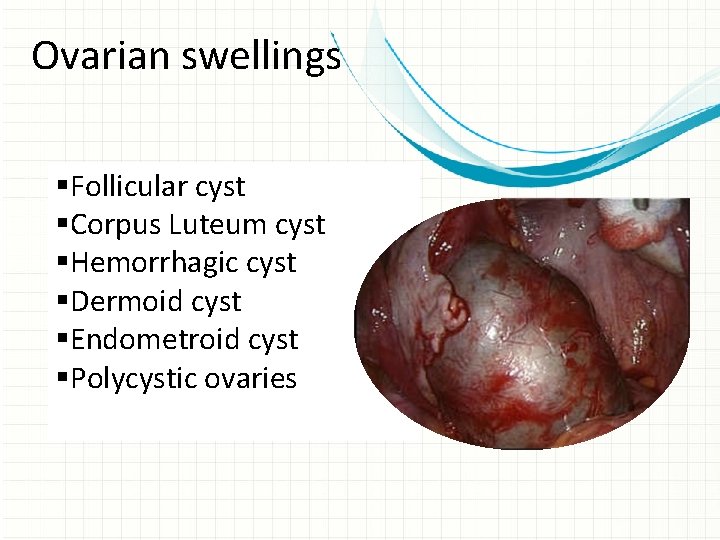 Ovarian swellings §Follicular cyst §Corpus Luteum cyst §Hemorrhagic cyst §Dermoid cyst §Endometroid cyst §Polycystic