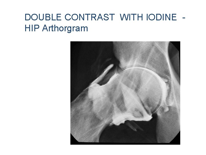 DOUBLE CONTRAST WITH IODINE HIP Arthorgram DOUBLE CONTRAST WITH IODINE HIP Arthorgram