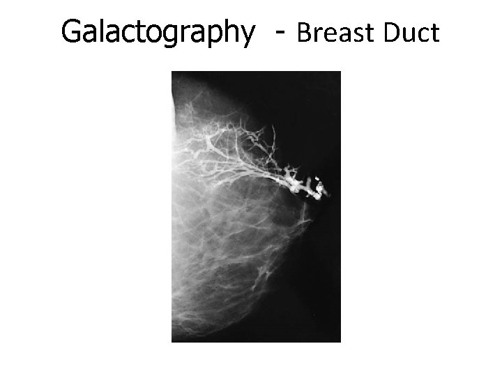 Galactography - Breast Duct 