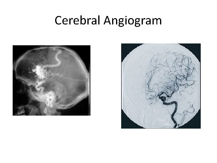 Cerebral Angiogram 