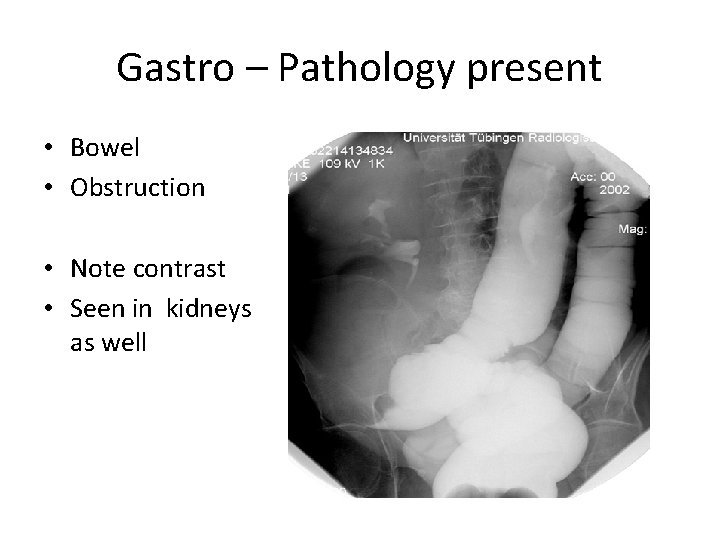 Gastro – Pathology present • Bowel • Obstruction • Note contrast • Seen in