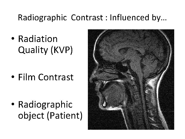 Radiographic Contrast : Influenced by… • Radiation Quality (KVP) • Film Contrast • Radiographic