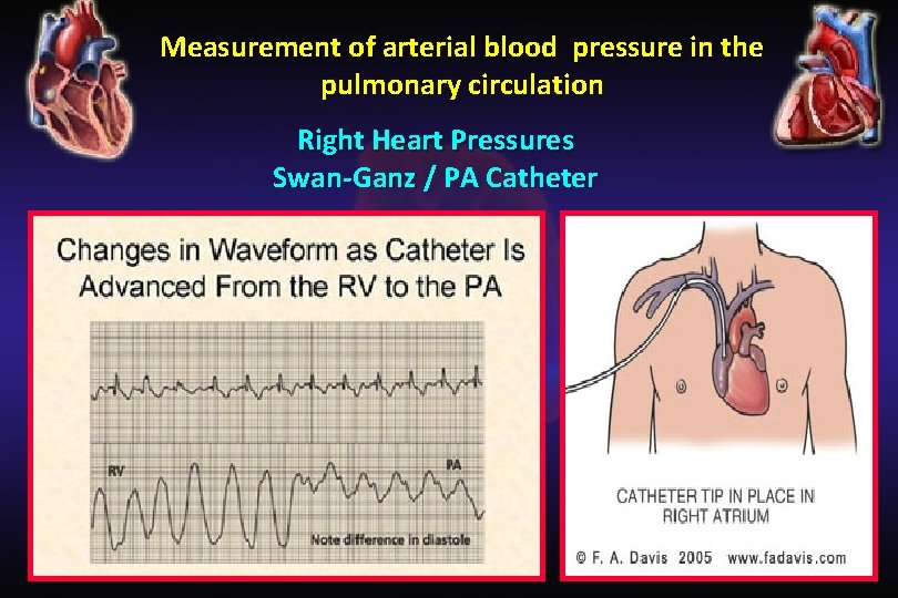 Measurement of arterial blood pressure in the pulmonary circulation Right Heart Pressures Swan-Ganz /