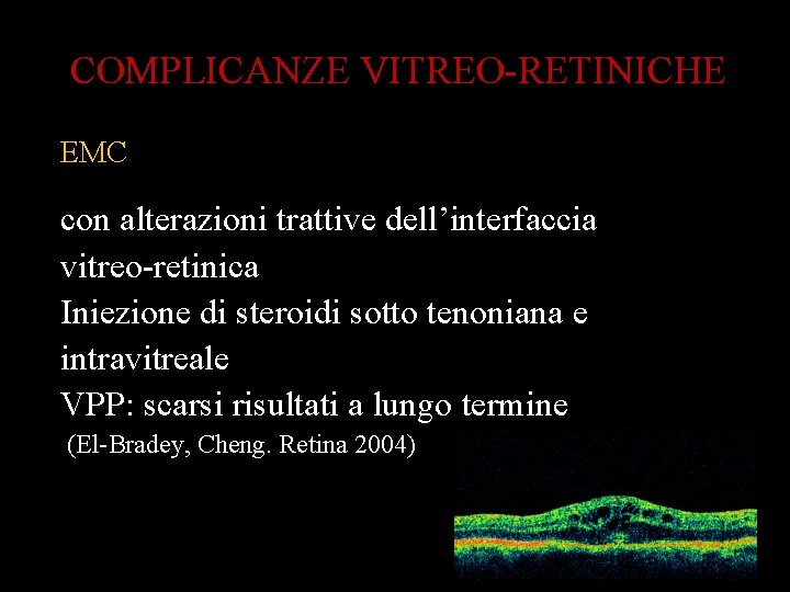 COMPLICANZE VITREO-RETINICHE EMC con alterazioni trattive dell’interfaccia vitreo-retinica Iniezione di steroidi sotto tenoniana e