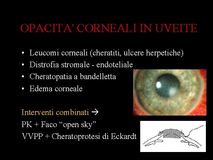 OPACITA' CORNEALI IN UVEITE • • Leucomi corneali (cheratiti, ulcere herpetiche) Distrofia stromale -
