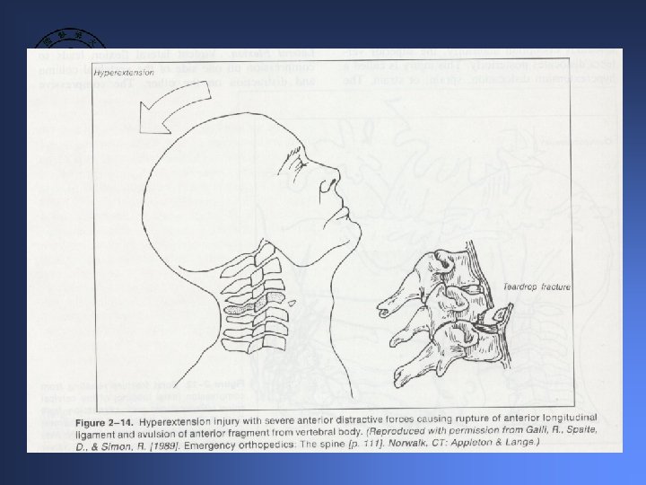 Sci Excessive Rotation Neurological Physical Therapy for Patient with SCI Complication