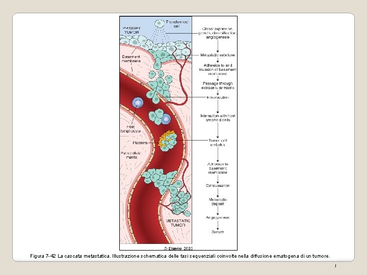 Figura 7 -42 La cascata metastatica. Illustrazione schematica delle fasi sequenziali coinvolte nella diffusione Figura 7 -42 La cascata metastatica. Illustrazione schematica delle fasi sequenziali coinvolte nella diffusione