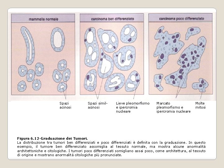 Spazi acinosi Spazi similacinosi Lieve pleomorfismo e ipercromia nucleare Marcato pleomorfismo e ipercromia nucleare Spazi acinosi Spazi similacinosi Lieve pleomorfismo e ipercromia nucleare Marcato pleomorfismo e ipercromia nucleare