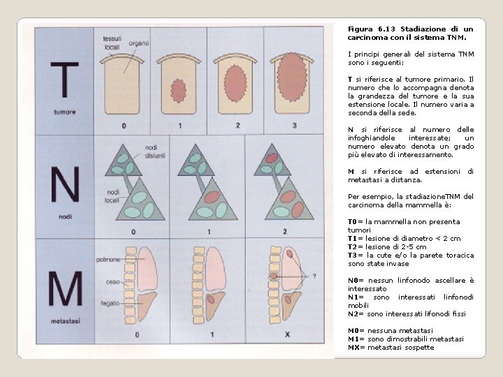 Figura 6. 13 Stadiazione di un carcinoma con il sistema TNM. I principi generali Figura 6. 13 Stadiazione di un carcinoma con il sistema TNM. I principi generali