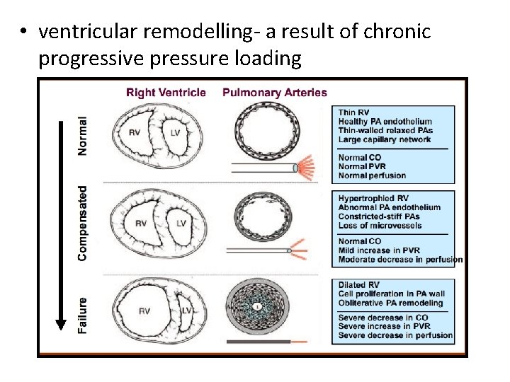  • ventricular remodelling- a result of chronic progressive pressure loading 