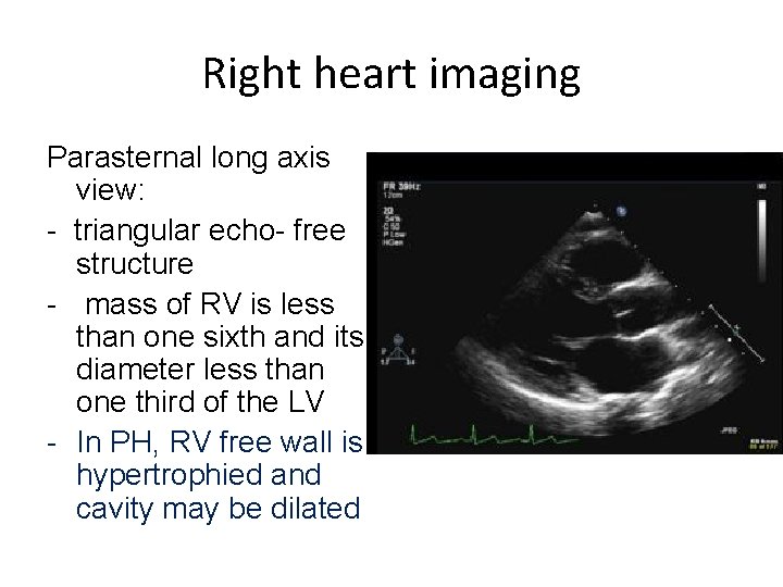 Right heart imaging Parasternal long axis view: - triangular echo- free structure - mass