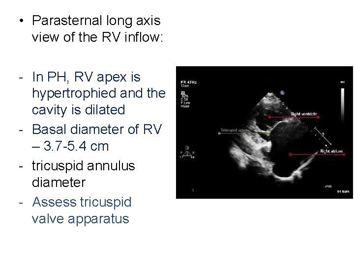  • Parasternal long axis view of the RV inflow: - In PH, RV