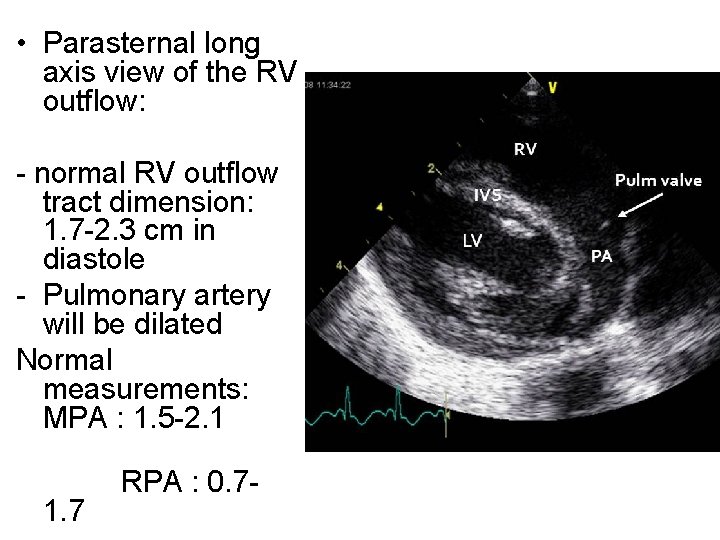  • Parasternal long axis view of the RV outflow: - normal RV outflow