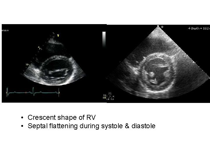  • Crescent shape of RV • Septal flattening during systole & diastole 
