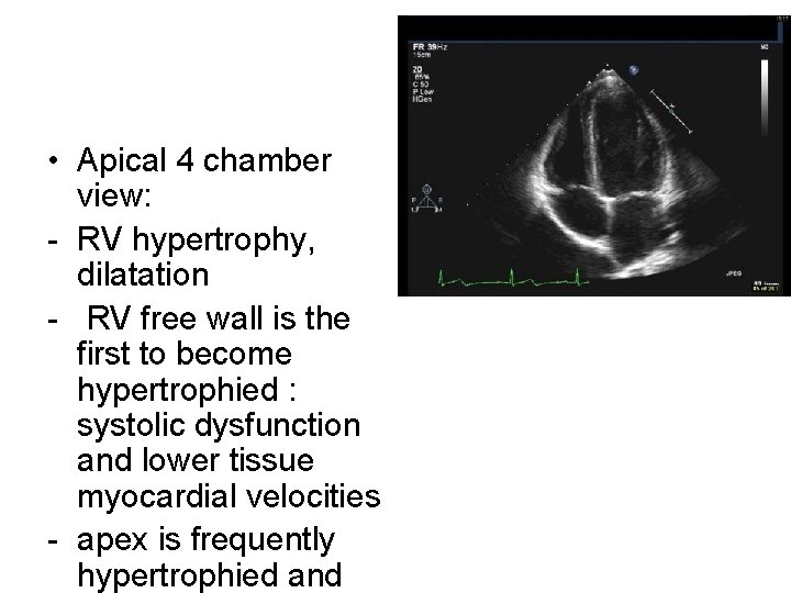  • Apical 4 chamber view: - RV hypertrophy, dilatation - RV free wall