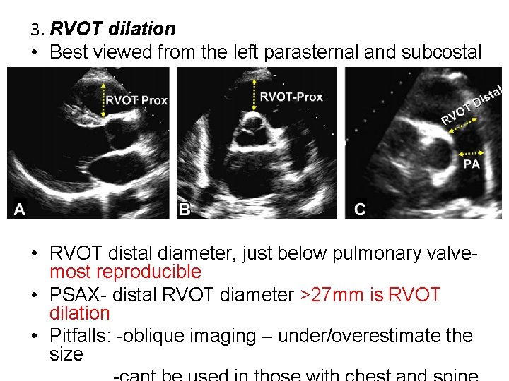 3. RVOT dilation • Best viewed from the left parasternal and subcostal view. •