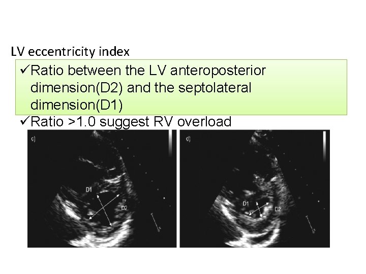 LV eccentricity index üRatio between the LV anteroposterior dimension(D 2) and the septolateral dimension(D