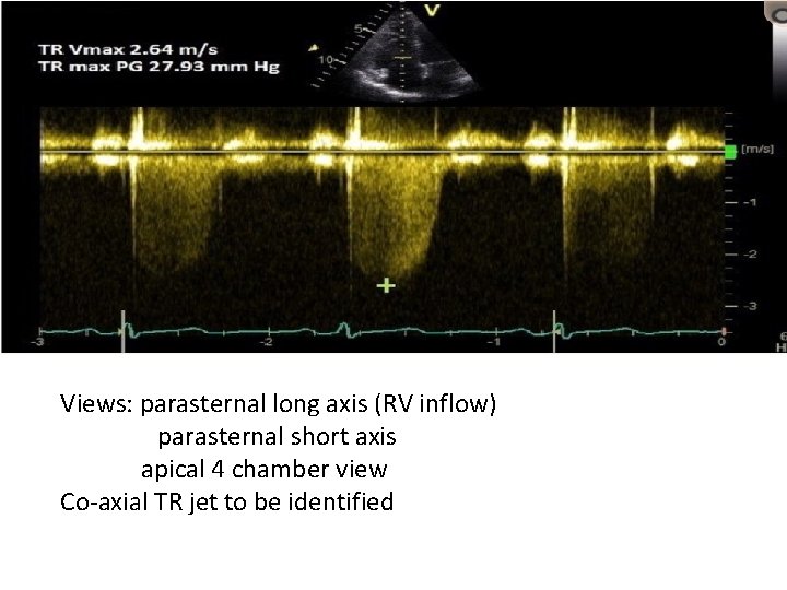 Views: parasternal long axis (RV inflow) parasternal short axis apical 4 chamber view Co-axial