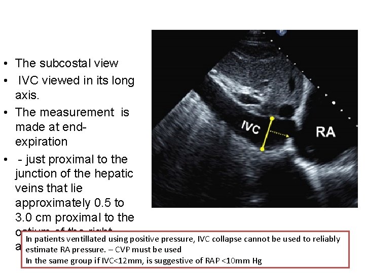  • The subcostal view • IVC viewed in its long axis. • The