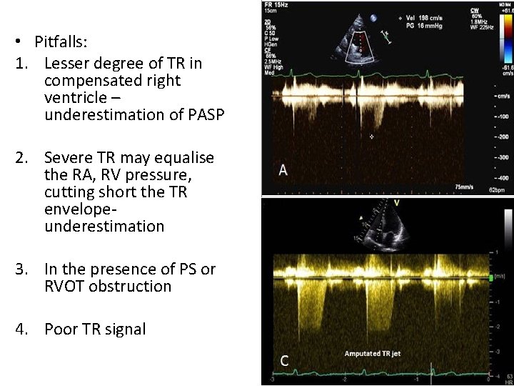  • Pitfalls: 1. Lesser degree of TR in compensated right ventricle – underestimation