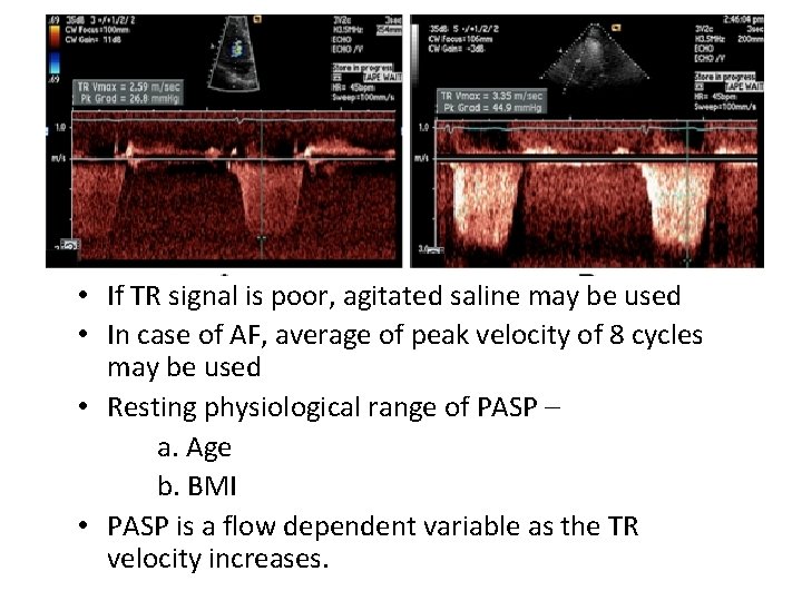  • If TR signal is poor, agitated saline may be used • In