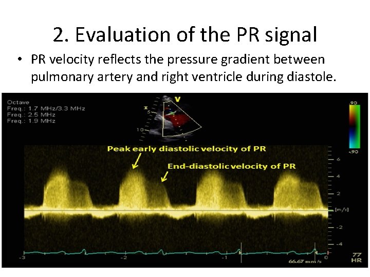 2. Evaluation of the PR signal • PR velocity reflects the pressure gradient between