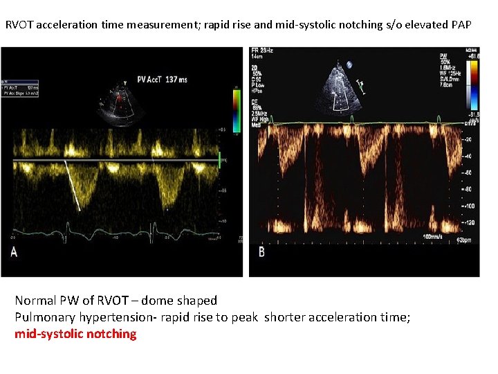 RVOT acceleration time measurement; rapid rise and mid-systolic notching s/o elevated PAP Normal PW