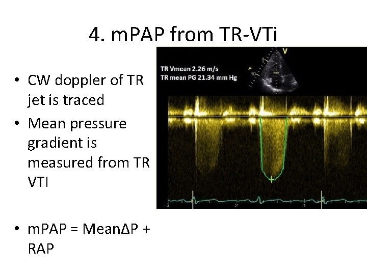 4. m. PAP from TR-VTi • CW doppler of TR jet is traced •
