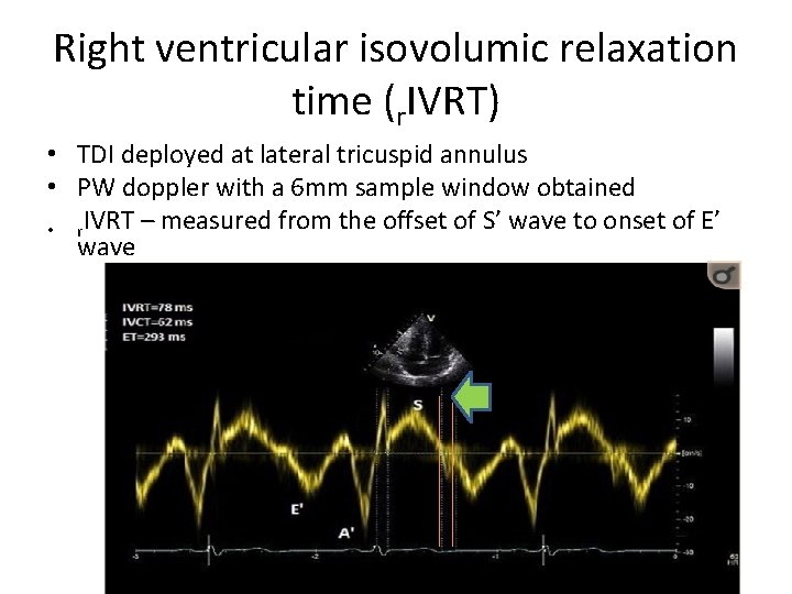 Right ventricular isovolumic relaxation time (r. IVRT) • TDI deployed at lateral tricuspid annulus