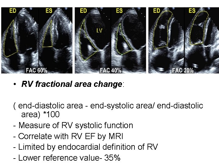  • RV fractional area change: ( end-diastolic area - end-systolic area/ end-diastolic area)