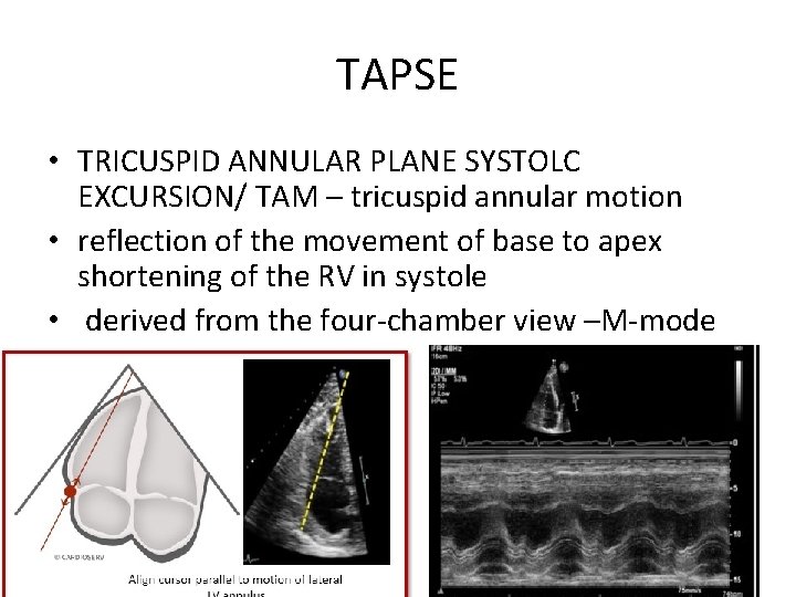 TAPSE • TRICUSPID ANNULAR PLANE SYSTOLC EXCURSION/ TAM – tricuspid annular motion • reflection