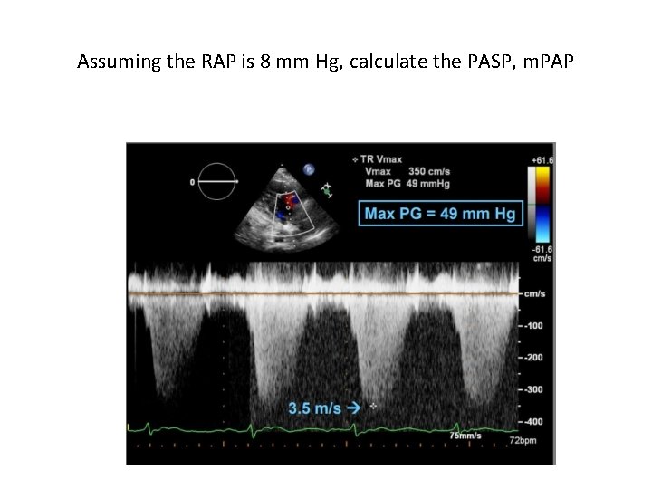 Assuming the RAP is 8 mm Hg, calculate the PASP, m. PAP 