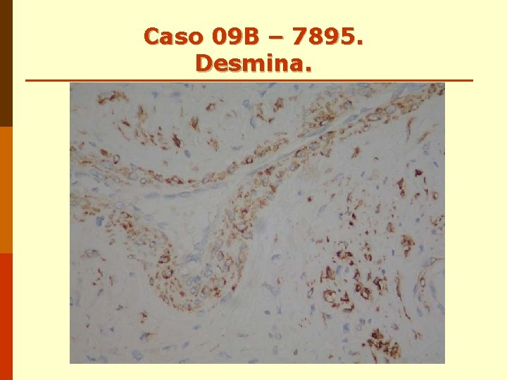 Caso 09 B – 7895. Desmina. Caso 09 B – 7895. Desmina.