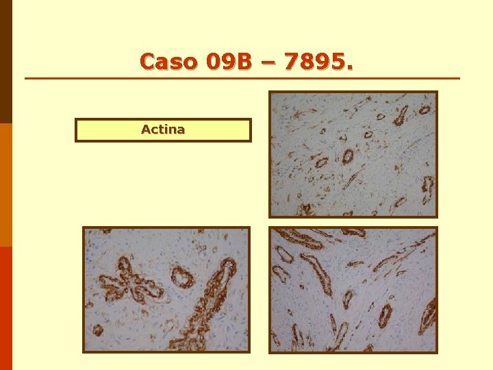 Caso 09 B – 7895. Actina Caso 09 B – 7895. Actina