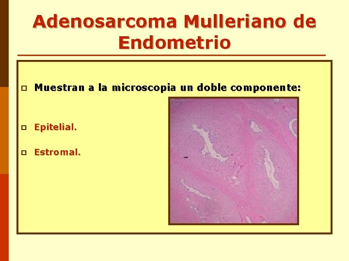 Adenosarcoma Mulleriano de Endometrio p Muestran a la microscopia un doble componente: p Epitelial. Adenosarcoma Mulleriano de Endometrio p Muestran a la microscopia un doble componente: p Epitelial.