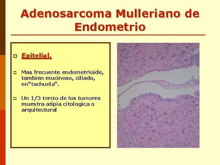 Adenosarcoma Mulleriano de Endometrio p Epitelial. p Mas frecuente endometrioide, tambien mucinoso, ciliado, en“tachuela”. Adenosarcoma Mulleriano de Endometrio p Epitelial. p Mas frecuente endometrioide, tambien mucinoso, ciliado, en“tachuela”.