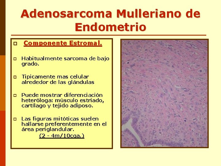 Adenosarcoma Mulleriano de Endometrio p Componente Estromal. p Habitualmente sarcoma de bajo grado. p Adenosarcoma Mulleriano de Endometrio p Componente Estromal. p Habitualmente sarcoma de bajo grado. p