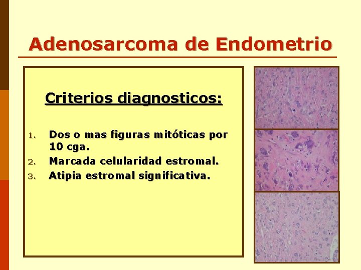 Adenosarcoma de Endometrio Criterios diagnosticos: 1. 2. 3. Dos o mas figuras mitóticas por Adenosarcoma de Endometrio Criterios diagnosticos: 1. 2. 3. Dos o mas figuras mitóticas por