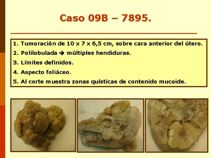 Caso 09 B – 7895. 1. Tumoración de 10 x 7 x 6, 5 Caso 09 B – 7895. 1. Tumoración de 10 x 7 x 6, 5