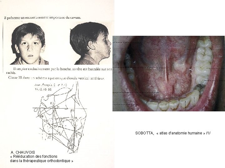 A. CHAUVOIS « Rééducation des fonctions dans la thérapeutique orthodontique » SOBOTTA, « atlas