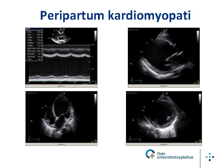 Peripartum kardiomyopati 