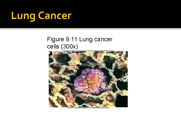 Lung Cancer Figure 9. 11 Lung cancer cells (300 x) 