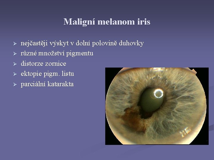 Maligní melanom iris Ø Ø Ø nejčastěji výskyt v dolní polovině duhovky různé množství