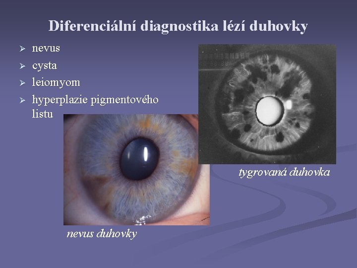 Diferenciální diagnostika lézí duhovky Ø Ø nevus cysta leiomyom hyperplazie pigmentového listu tygrovaná duhovka