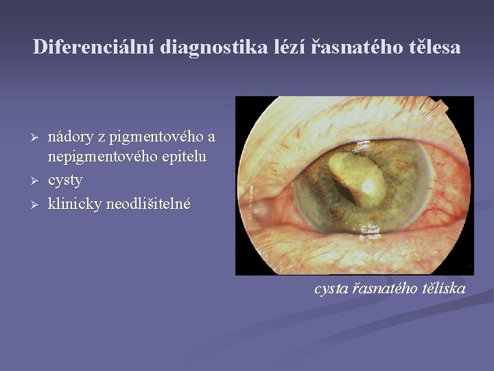 Diferenciální diagnostika lézí řasnatého tělesa Ø Ø Ø nádory z pigmentového a nepigmentového epitelu