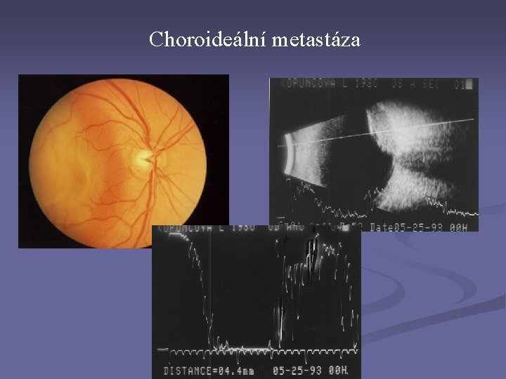 Choroideální metastáza 