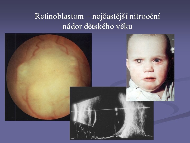 Retinoblastom – nejčastější nitrooční nádor dětského věku 