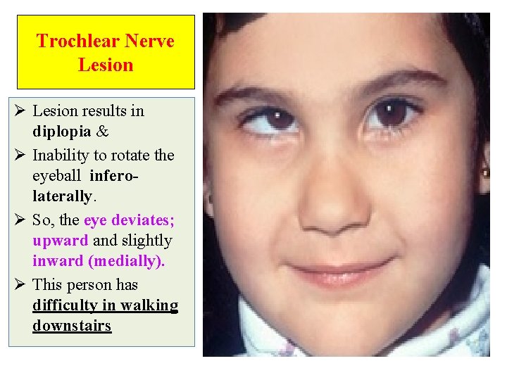 Trochlear Nerve Lesion Ø Lesion results in diplopia & Ø Inability to rotate the