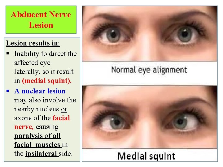 Abducent Nerve Lesion results in: § Inability to direct the affected eye laterally, so